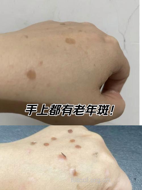 搓手搓脸可有效祛除老年斑