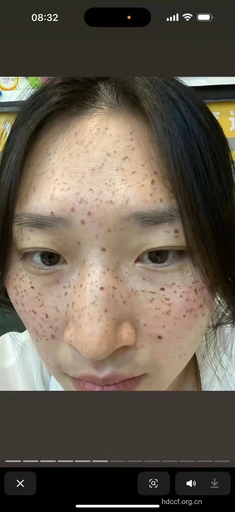 可爱的雀斑怎么来的