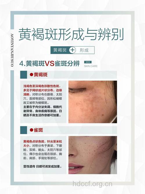 黄褐斑是这样产生的？