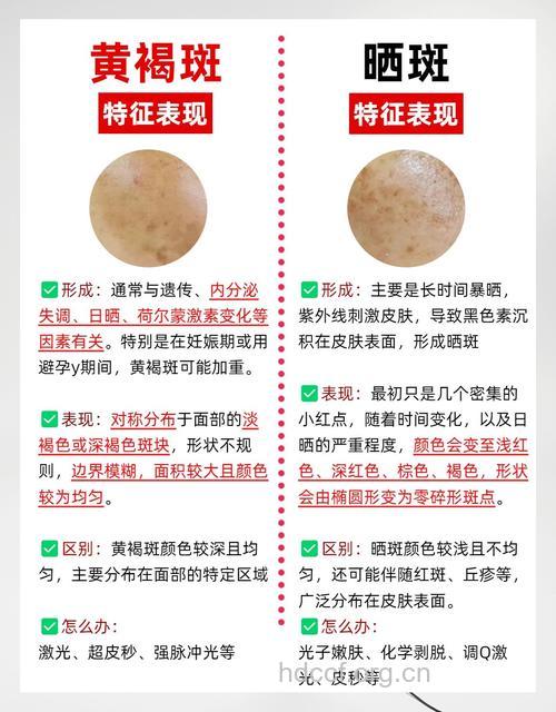 黄褐斑的诊断要点及鉴别