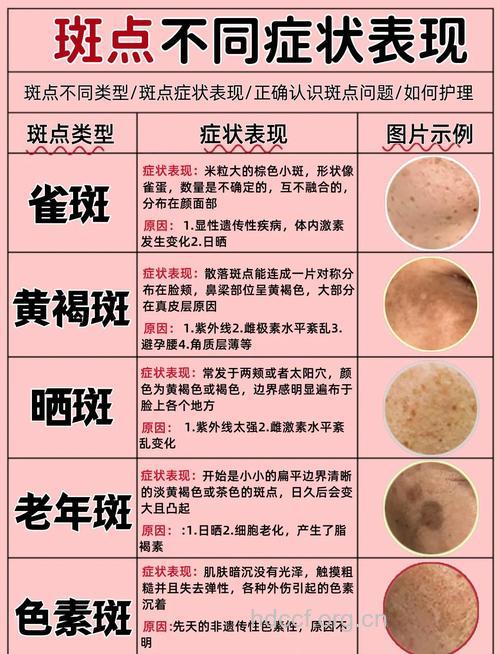 认识黄褐斑的3种类型