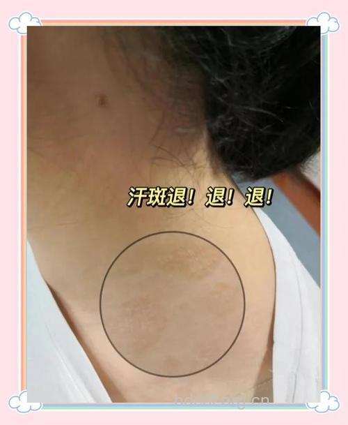 黄褐斑暴晒后用凉开水降温