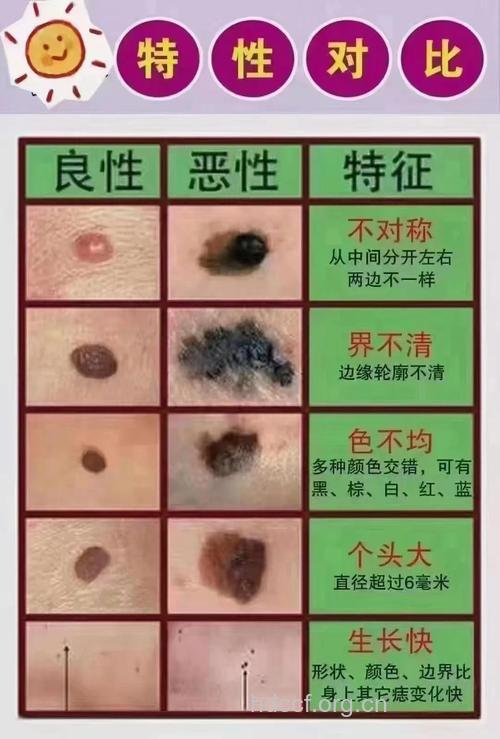 哪些痣容易变成癌