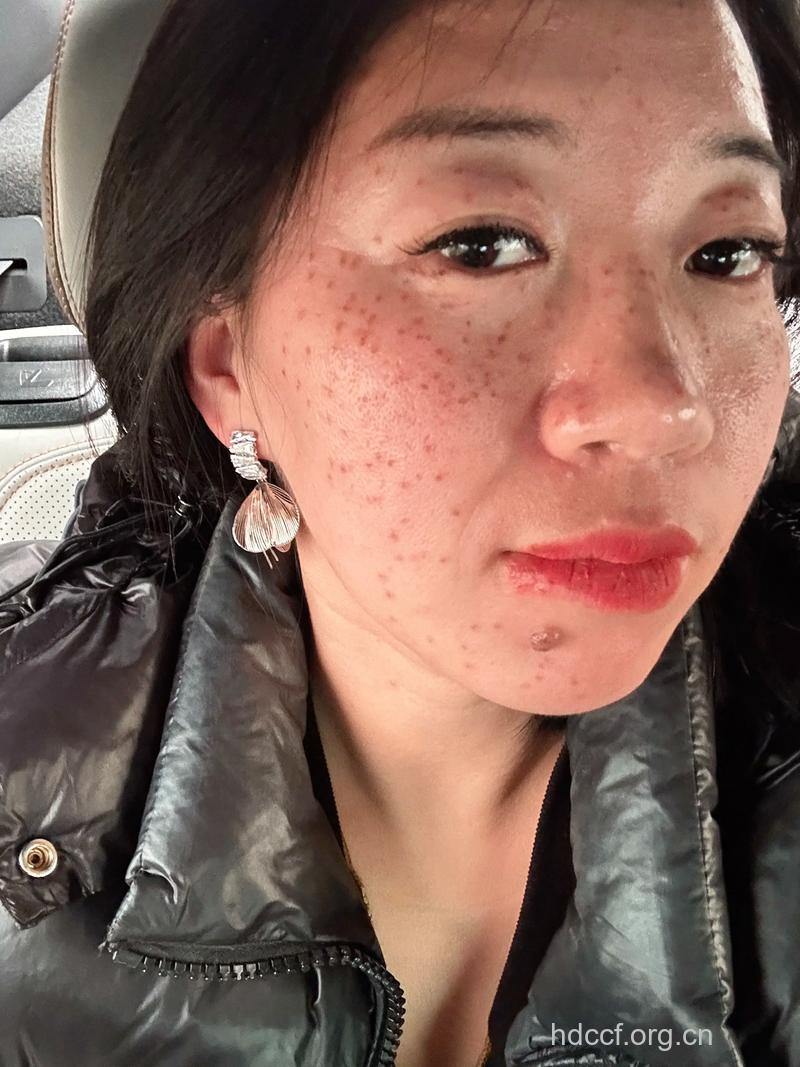 女性食盐过多易招惹雀斑