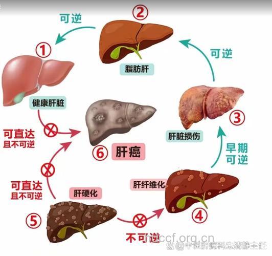 从乙肝到肝癌如何演变