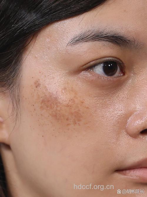 女性的“皮肤杀手”:色斑