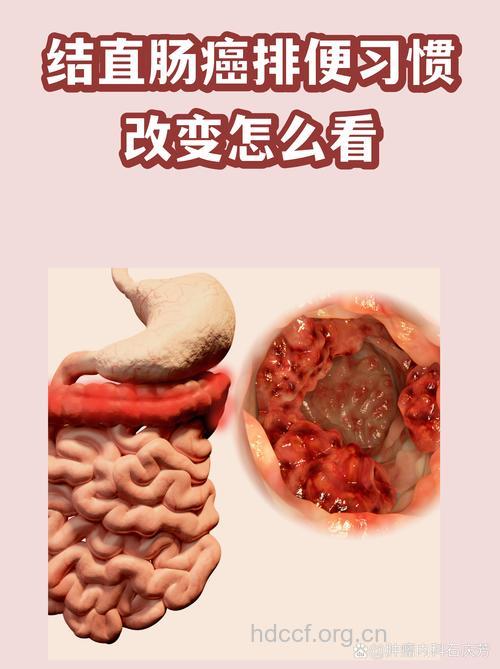 排便习惯改变,需警惕肠道癌症