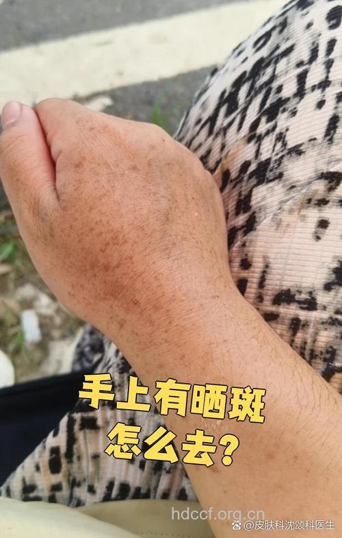 春天来了 小心皮肤晒出斑