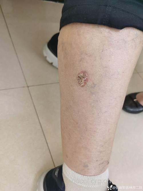 接吻可传播皮肤癌