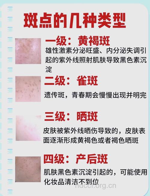 美颜计:雀斑肌肤保养有方