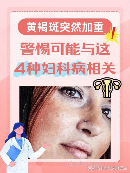 案例分析：脸上褐斑多 子宫肌瘤是“首恶”