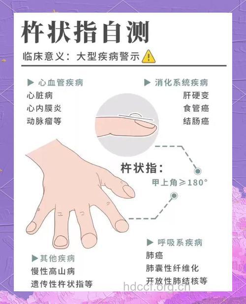 直肠癌预防的“金手指”