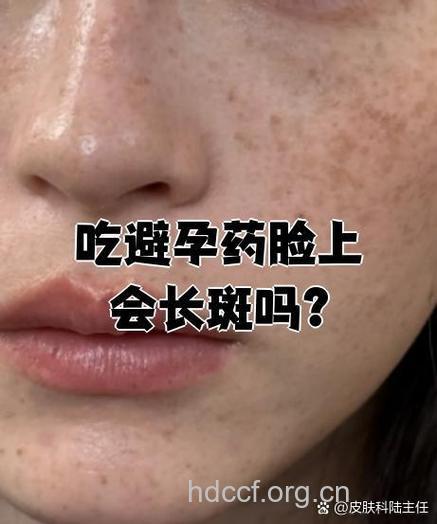 口服避孕药容易长斑吗？