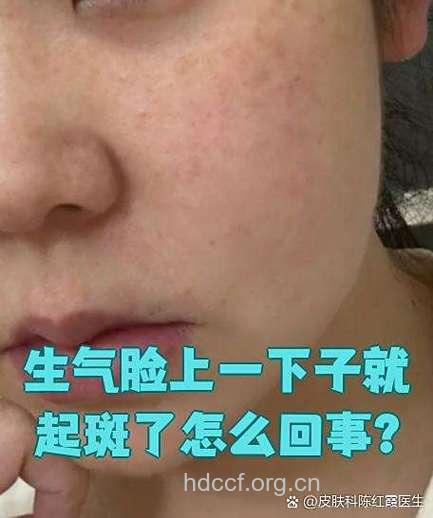 惊！女人生气会诱发色斑