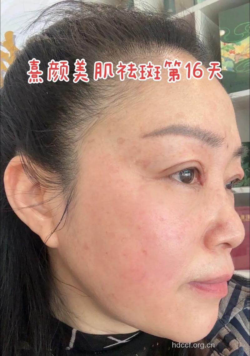 轻松搞定色斑 焕发迷人光彩