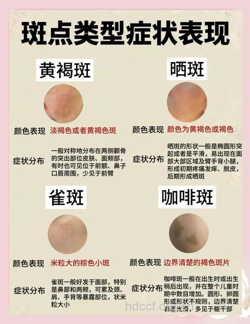 摆脱黄褐斑不再是梦！