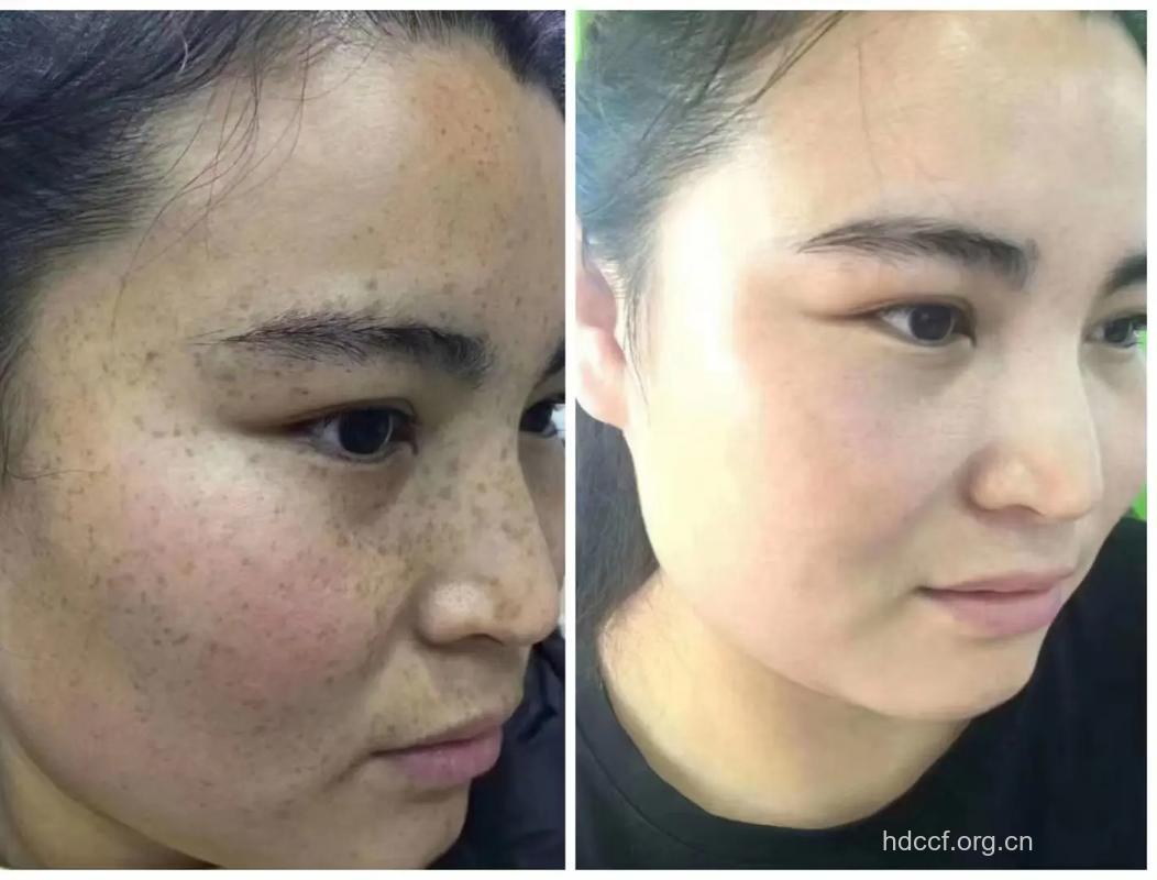 如果没有雀斑,我会更自信!