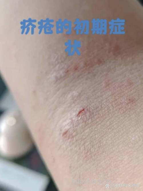 全家痒不停或是疥疮在作怪