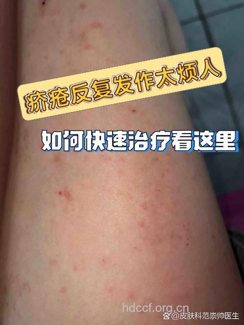 关于疥疮有什么发病特点