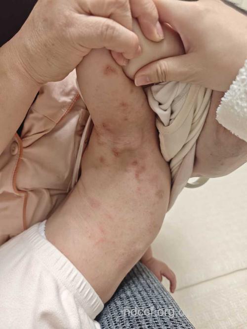 婴幼儿疥疮的临床表现