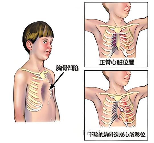 为什么儿童不能做胸透