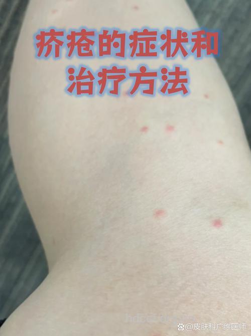 疥疮容易在集体生活中感染