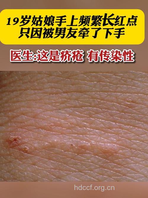 你知道疥疮的传染性有多强吗?