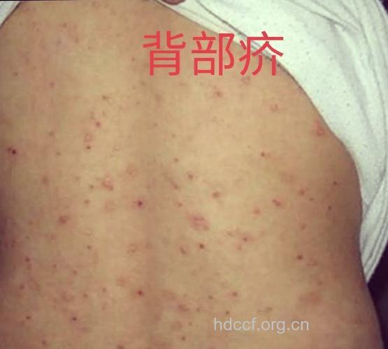 疥疮有哪些特殊类型呢