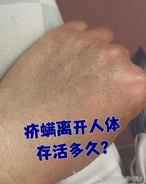 小心 疥虫离开人体后尚能生存