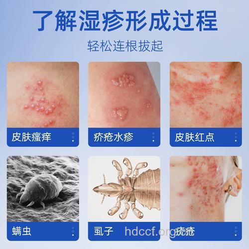 疥疮用什么药好?