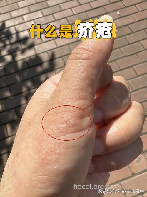 疥疮的临床表现