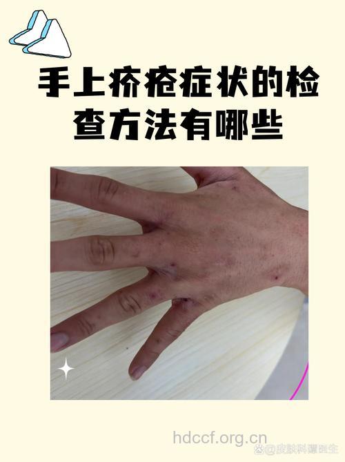 得了疥疮应做哪些检查？
