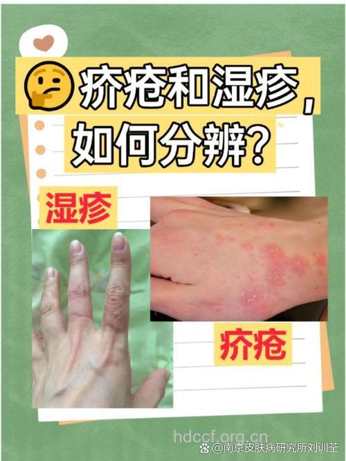 别让疥疮并发症跟着你