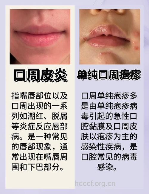 嘴上起黄水疮怎么办