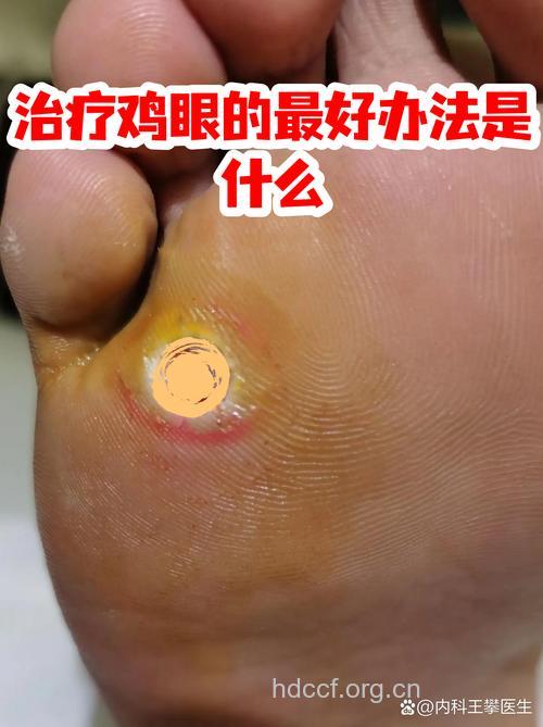 鸡眼影响行走应该如何治疗