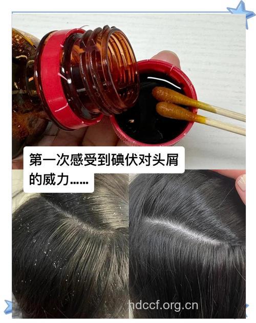 原来头皮屑要这么治疗