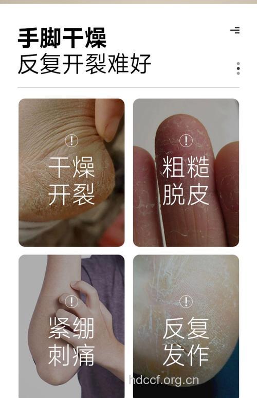 冬季治疗手足皲裂的方法