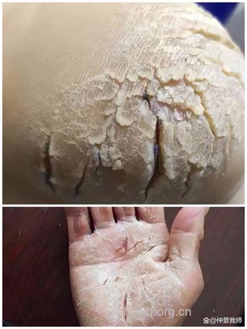 手脚皲裂可试试4大中医方