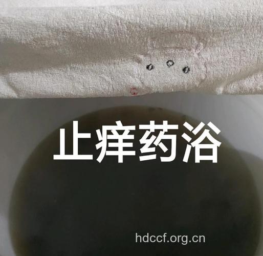 适合皮肤病的药浴有哪些