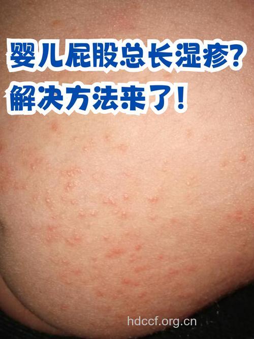 屁股周边湿疹怎么回事