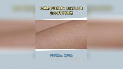 鱼鳞病患者要学会自我护理