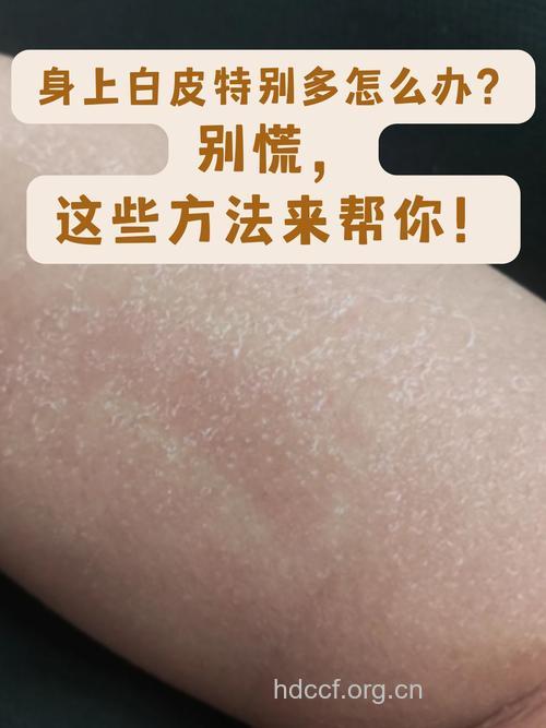 为何白领更容易患皮肤病