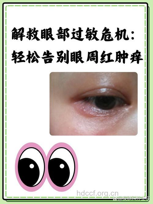 眼部过敏如何止痒呢