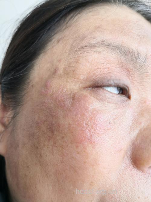 易患日光性皮炎人有哪些呢