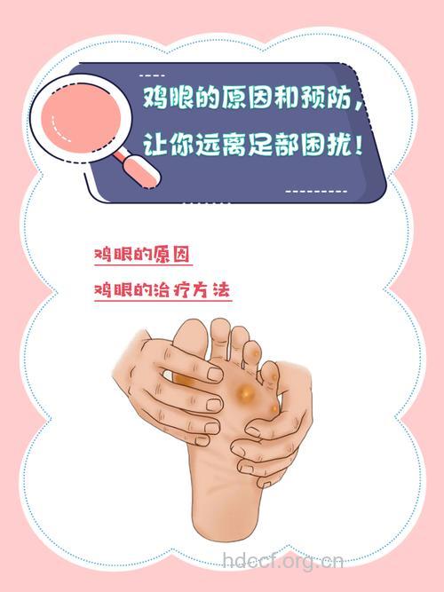 日常生活预防鸡眼从何做起呢