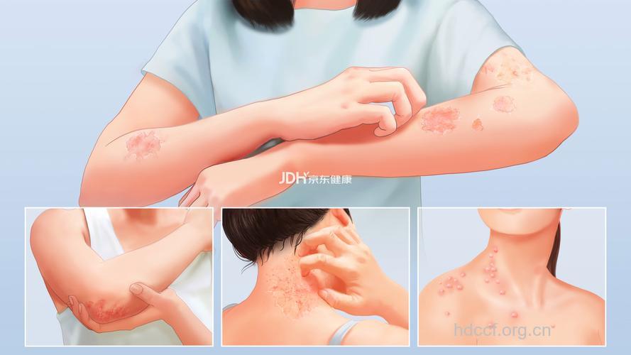 彩绘时髦需小心过敏性皮炎