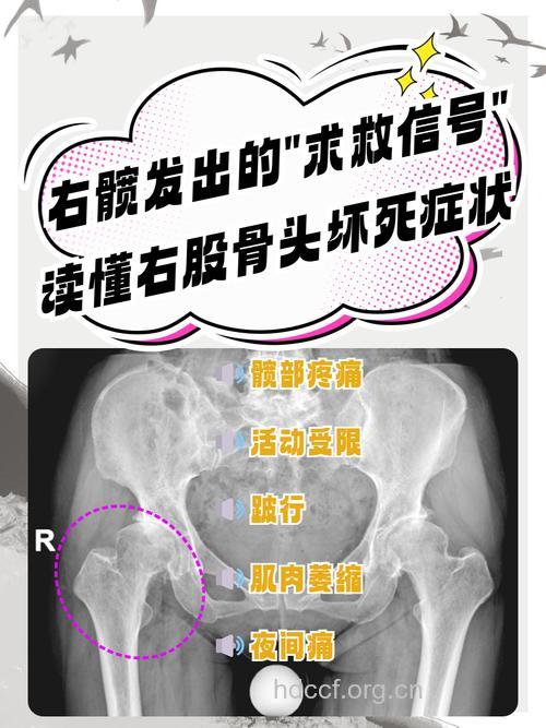 教你如何从X片上看骨头坏死
