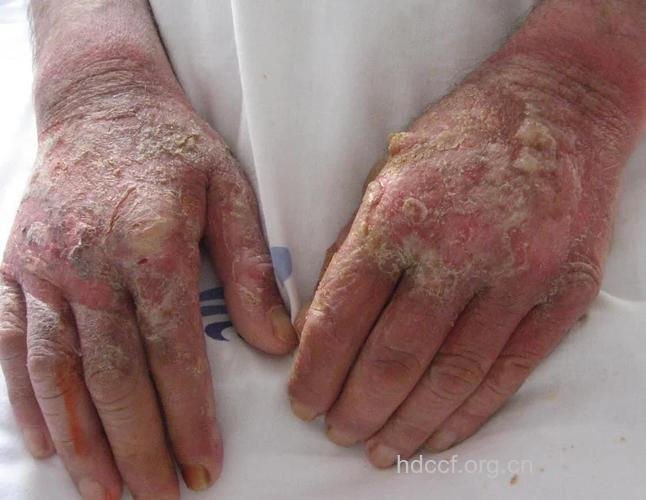 小心抽烟会引发皮肤病