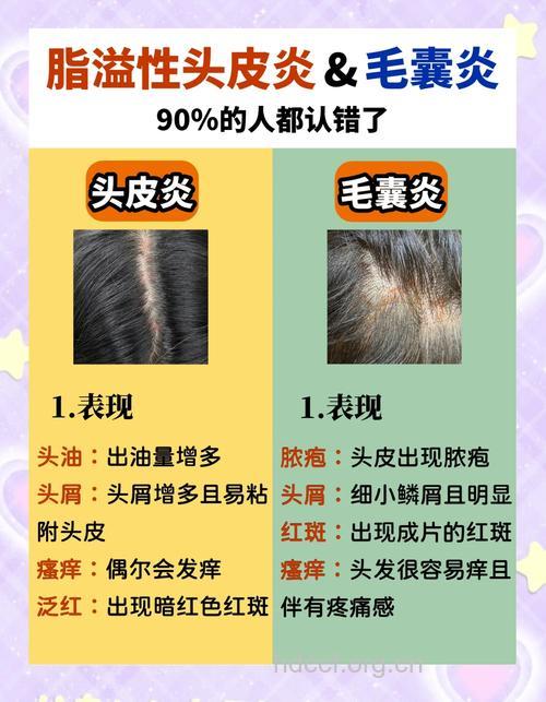 染头发会导致皮炎该怎么办