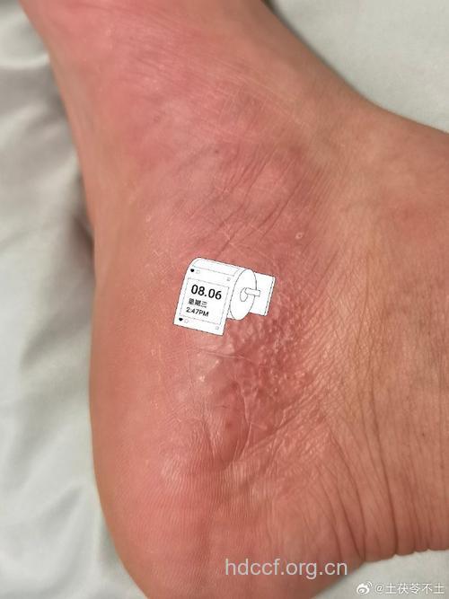 连续性肢端皮炎的饮食保健方法